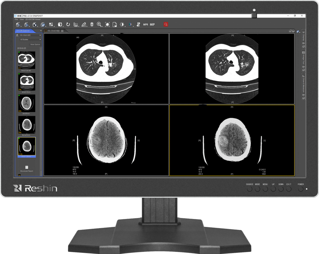 骨科影像迈向智能化时代,凯利泰助力精准诊疗